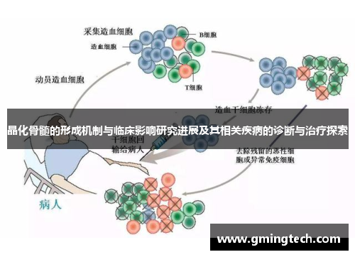 晶化骨髓的形成机制与临床影响研究进展及其相关疾病的诊断与治疗探索 晶化骨髓的形成机制与临床影响研究进展及其相关疾病的诊断与治疗探索